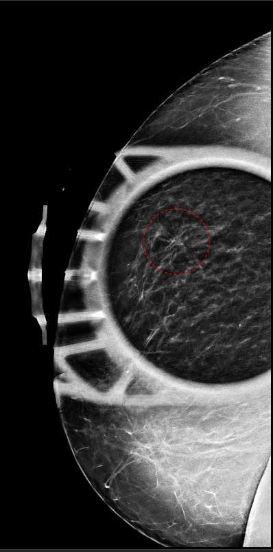 Spot compression views showing persistent architectural distortion in the lateral right breast, confirming true parenchymal distortion.