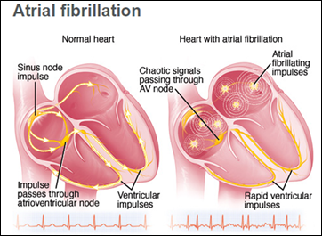 Atrial fibrillation