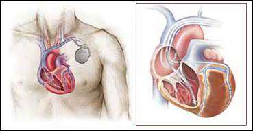 Image of a heart exemplifying laser lead extraction