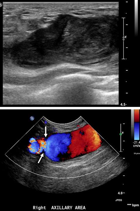 Pseudoaneurysm