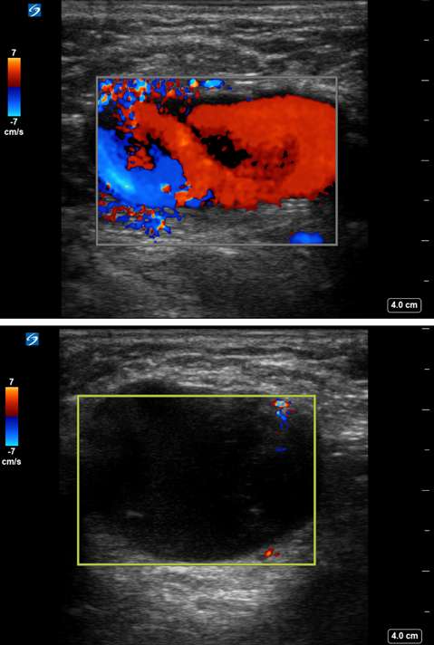 Pseudoaneurysm.