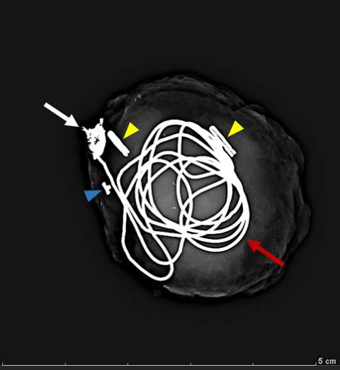 Pseudoaneurysm.
