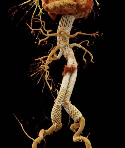 Aortic Scan