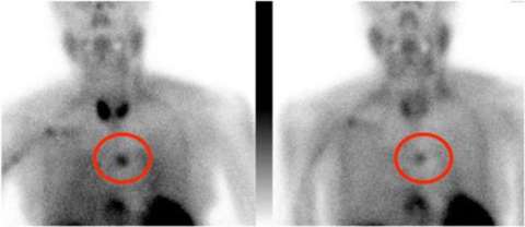 Nuclear Medicine Scan or Sestamibi
