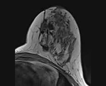 Breast MRI Findings: Post-surgical Findings