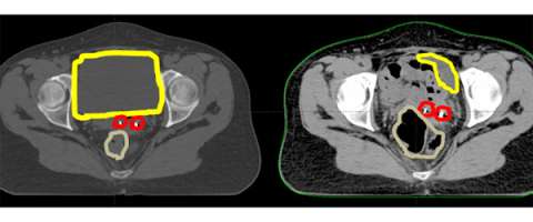 CT Scan