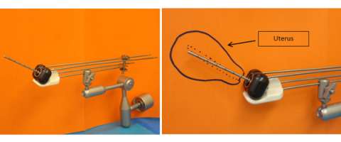 intracavitary applicator