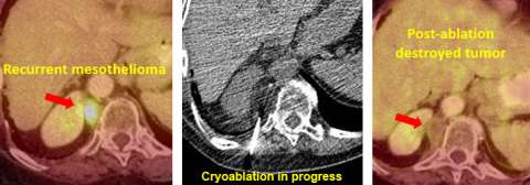 Three step diagram of cryoablation process