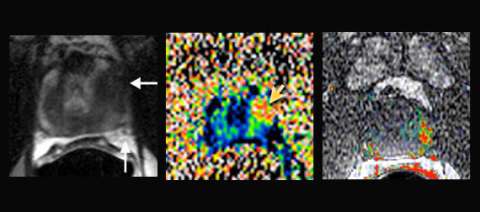 Example of Change to Nerve Sparing