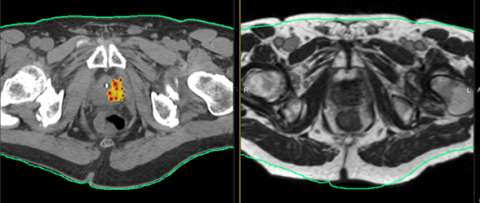 prostate cancer