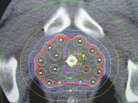 prostate dosing