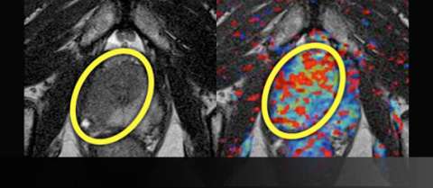 Radiation Therapy Follow-Up