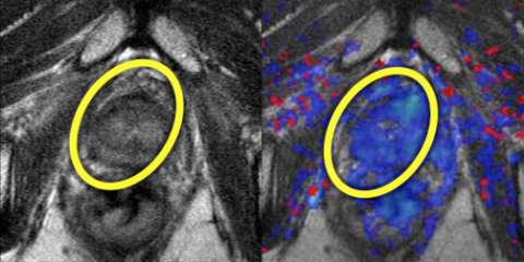 Radiation therapy images of decreased prefusion