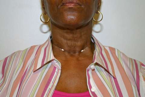 Scar appearance 3 months after surgery