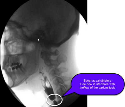 Esophageal Stricture