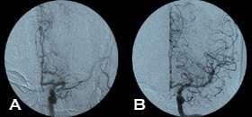 Stroke - Angio