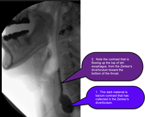 Zenker's Diverticulum