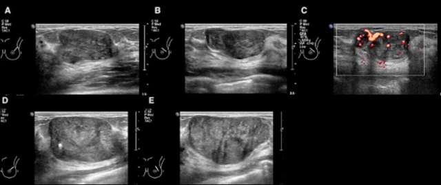 Case: Phyllodes Tumors Figure 1