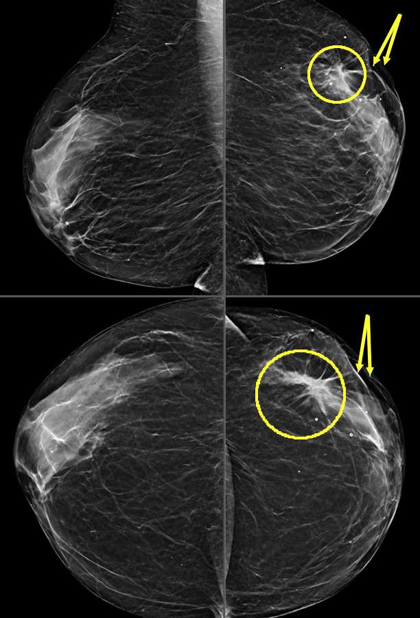 Case: Skin and Nipple Changes