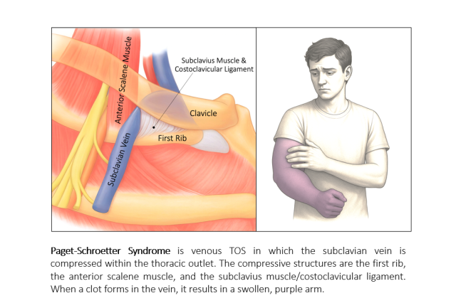 Paget-Schroetter Syndrome