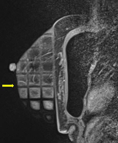 Procedure: MR Guided Breast Biopsy Figure 1