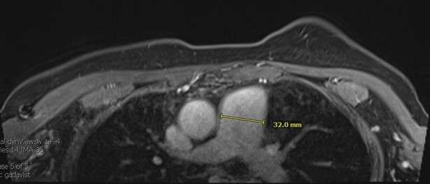 Case: Non Breast Finding Seen on Breast Imaging Figure 2