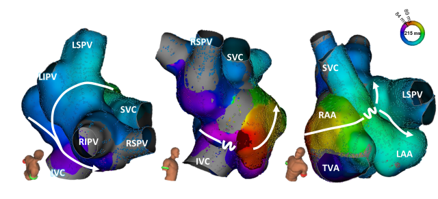 Three views of left atrial electroanatomical maps showing color-coded activation times and sequence (arrows) around pulmonary veins and major vessels.