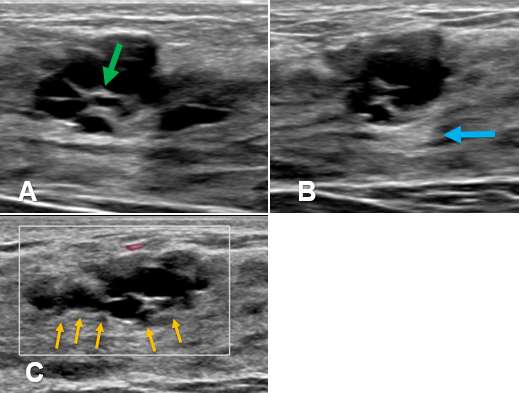 Case: Cysts figure 3