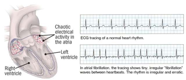 Heart diagram with chaotic atrial electrical signals and an irregular ECG tracing