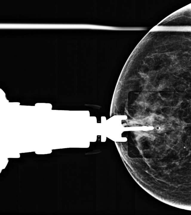 How to perform: Sterotactic (Mammographic guided biopsy) Figure 6