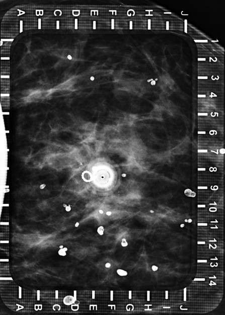 Procedure Mammographically Guided Wire Localizations Figure 2