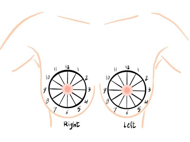 Screening Mammogram: Breast Lesion Localization Figure 1