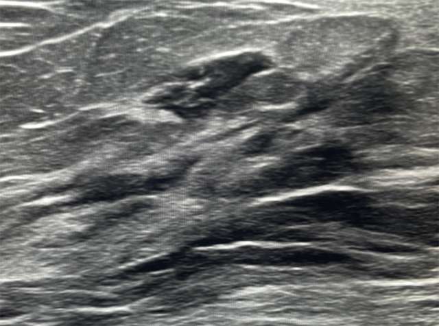 Case: Lymphoma of the Breast Figure 2