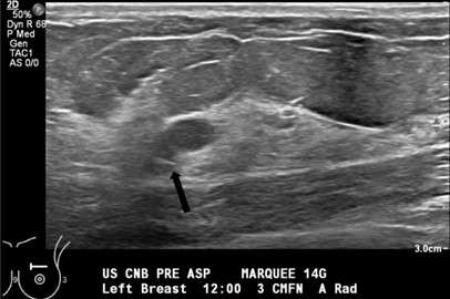 Procedure: US Guided Cyst Aspiration Figure 2