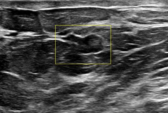 Case: Breast Ductal Anatomy and Function Figure 5