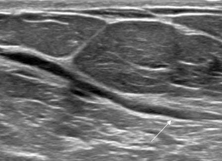 Case: Breast Ductal Anatomy and Function Figure 2
