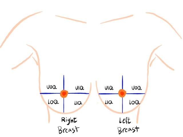 Screening Mammogram: Breast Lesion Localization Figure 4
