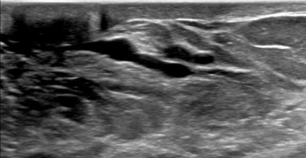 Case: Breast Ductal Anatomy and Function Figure 1