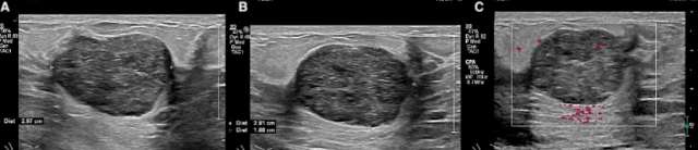 Case: Fibroadenomas and Phyllodes Tumors Figure 1
