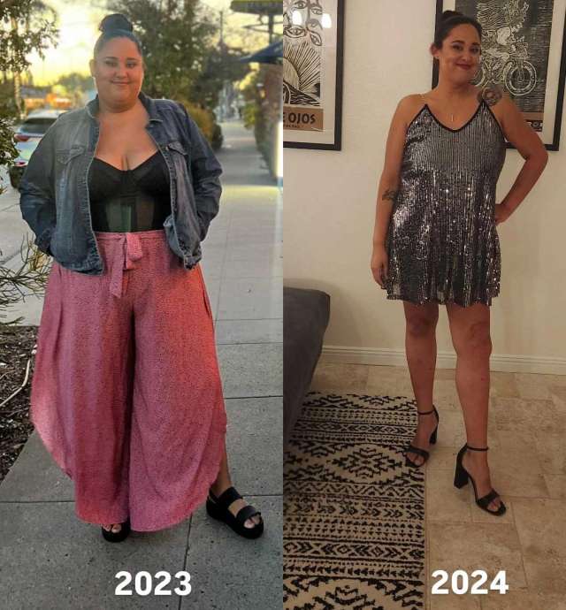 Vanessa's before and after photo, Gastric Sleeve Surgery at UCLA