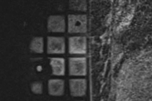 Radiology Breast Imaging Teaching Resources: Procedures