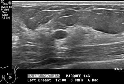 Procedure: US Guided Cyst Aspiration Figure 3