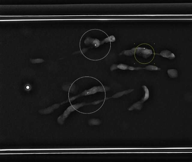 How to perform: Sterotactic (Mammographic guided biopsy) Figure 5