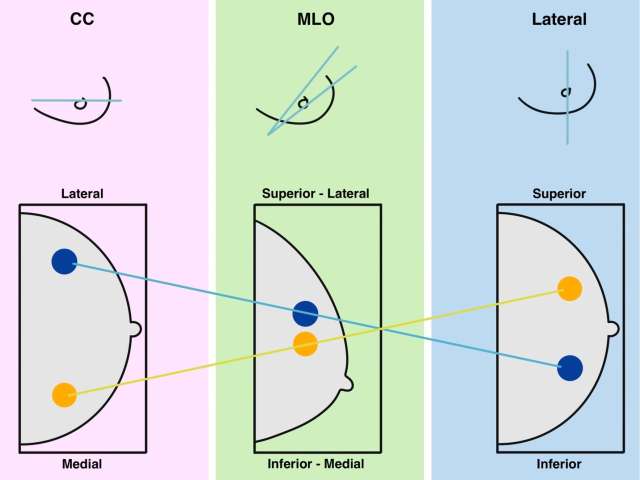 Screening Mammogram: Breast Lesion Localization Figure 5