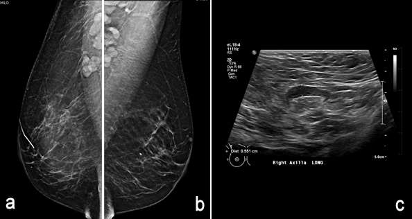 Case: Axillary Lymphadenopathy Figure 5