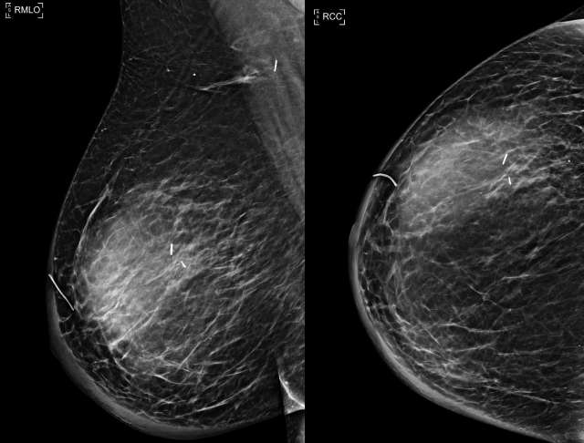 Case: Post-Surgical Fluid Collections Figure 5