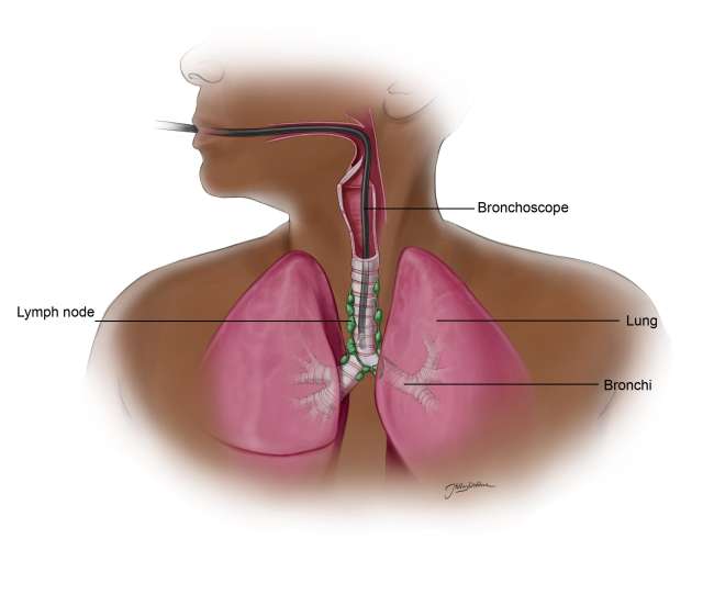 Illustration of endobronchial ultrasound (EBUS) related to pleural mesothelioma.