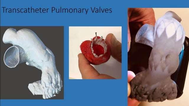 pulmonary valves