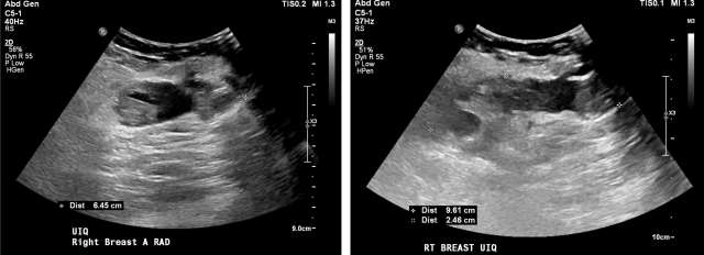 Case: Post-Surgical Fluid Collections Figure 2