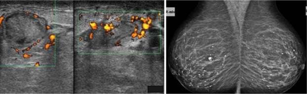 Case: Mastitis Figure 2